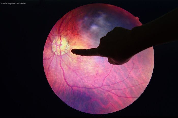 According to investigators, Phase I results demonstrated evidence of improvement in vision and retinal structure in patients with DME and AMD sustained through 12 weeks. 