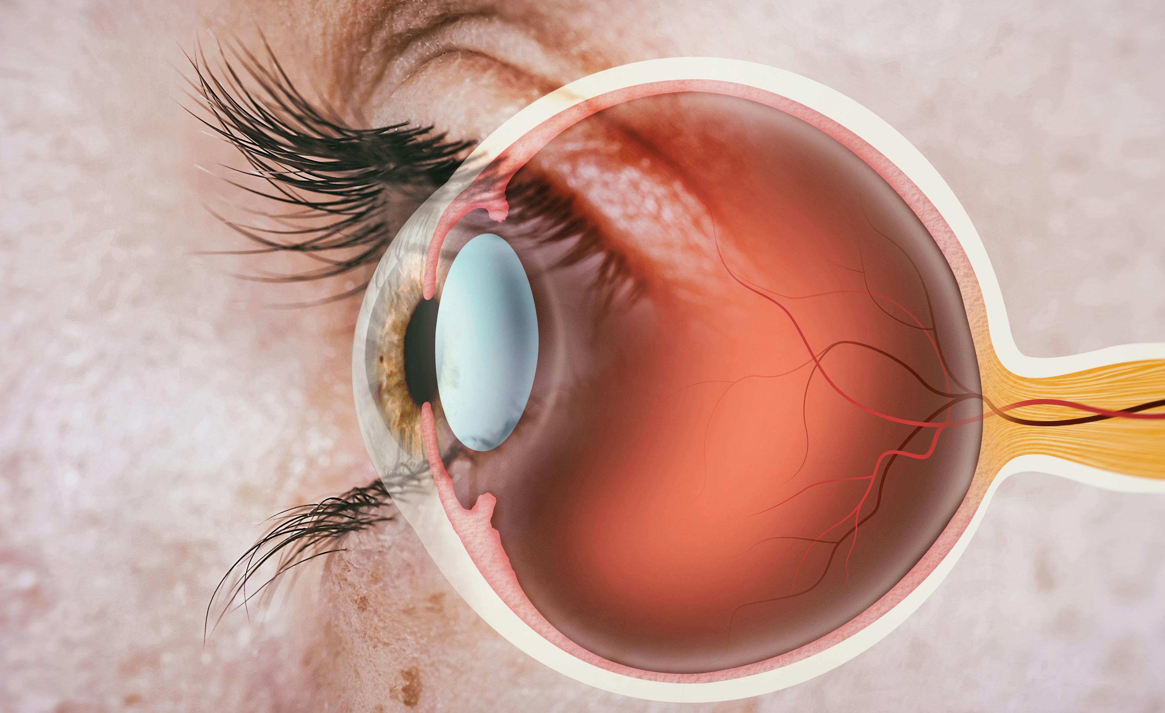 Researchers discovered that all patients had similar single surgery success rates but that minority patients had significantly worse vision outcomes and were more likely to have multiple retinal breaks.