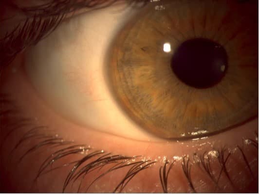 This normal-appearing eye has non-obvious MGD. (Photo courtesy Alice Epitropoulos, MD)