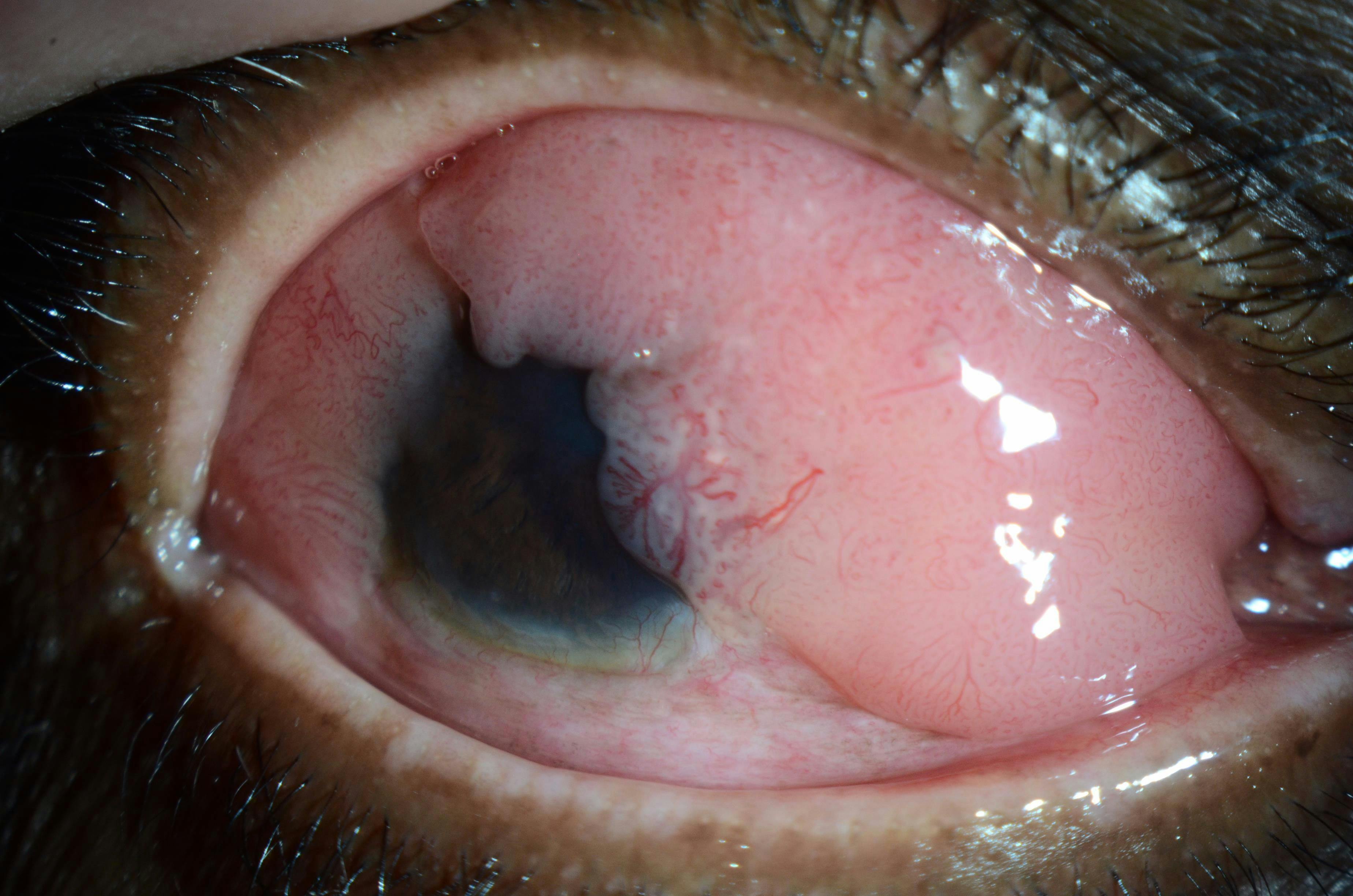 Ocular surface tumors: Rare but deadly