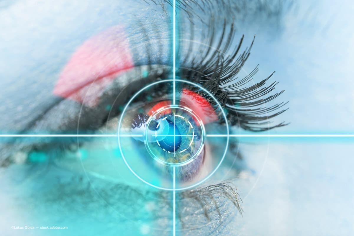 FDA clears glaucoma laser device from BELKIN Vision