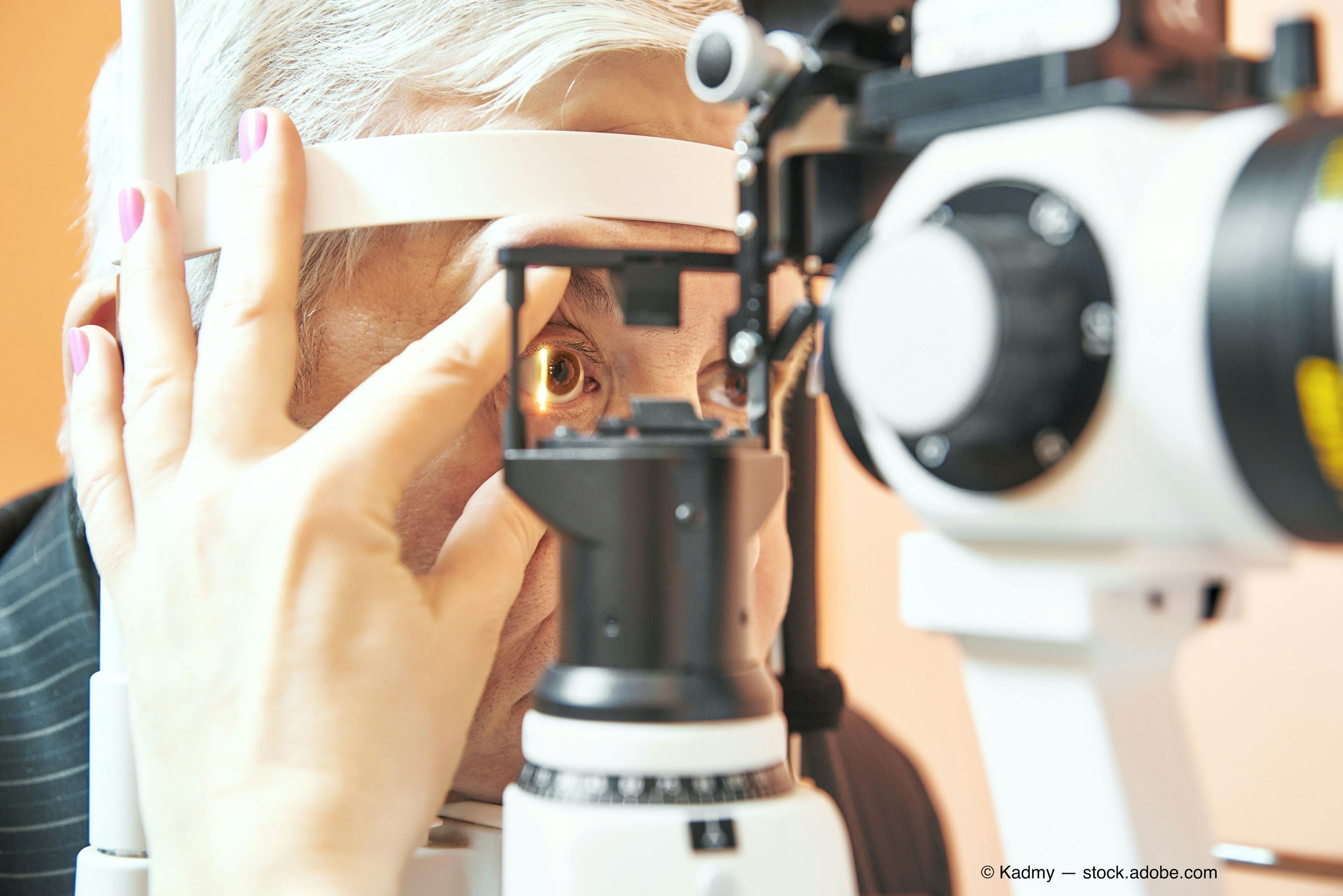 NCX 470, a novel NO-donating bimatoprost eye drop, is currently in Phase 3 clinical development for the lowering of IOP in patients with open-angle glaucoma or ocular hypertension.(Image courtesy of Adobe Stock)