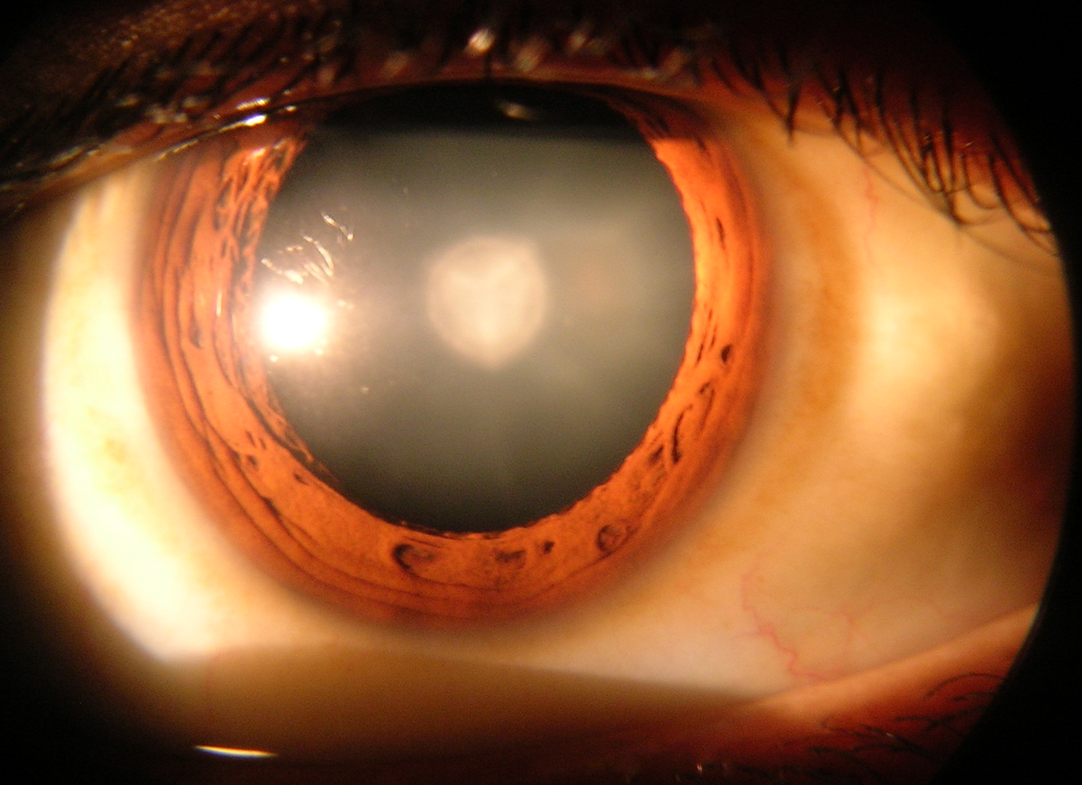 Investigators found significant associations of self-reported cataract surgery with all-cause and vascular mortalities. 