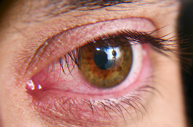 More than meets the eye: Researchers uncover the microbial secrets of dry eye