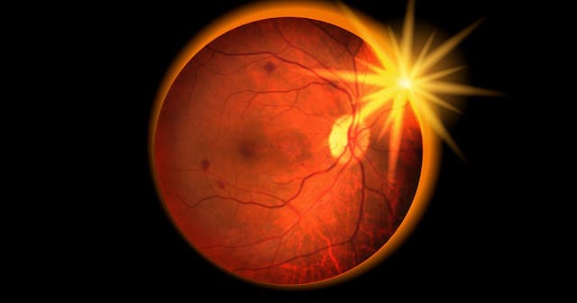 Diagnosis and management of solar retinopathy