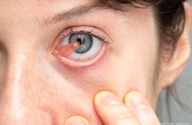 Survey by Cloudbreak Pharma shows patient frustration in treatment options for pterygium