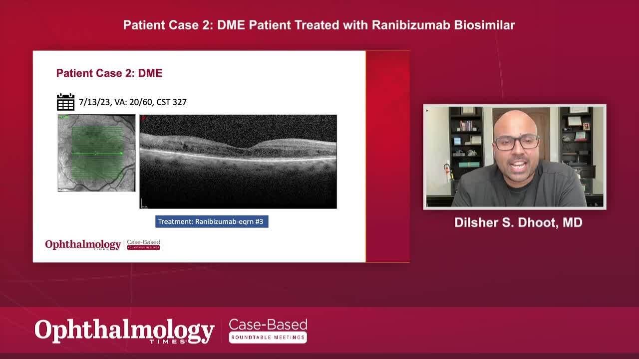 Patient case 2: DME Patient Treated with Ranibizumab Biosimilar