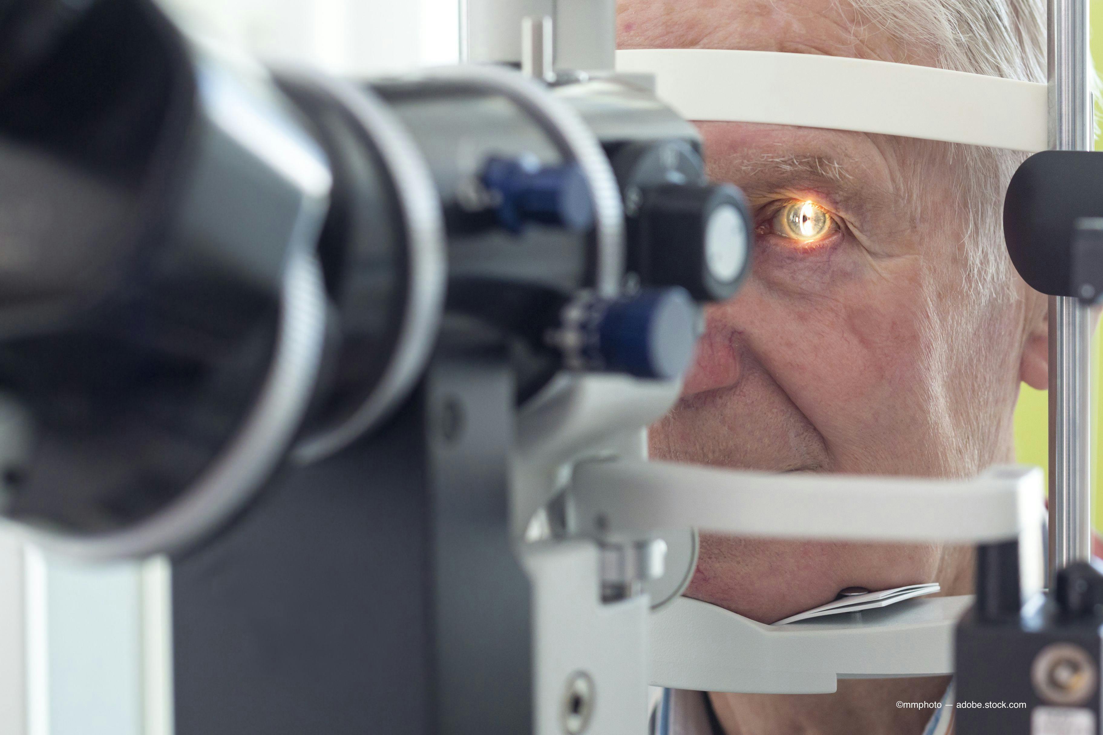  the combined femtosecond laser and phacoemulsification system will be the first system to combine these technologies, changing the paradigm in cataract surgery. (Images courtesy of Adobe Stock)