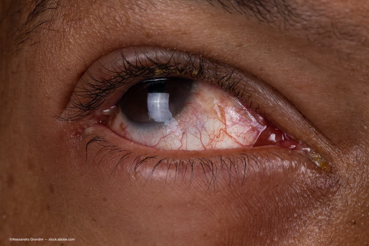 Conjunctivitis (pink eye) sees a spike in cases in Vietnam, India and Pakistan