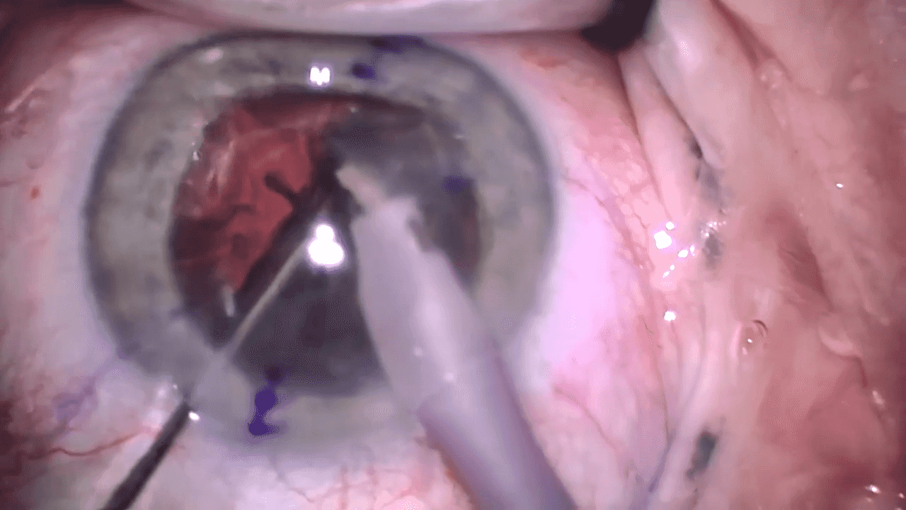 Arun Gulani, MD: How the Gni instrument enhances precision and control in cataract surgery