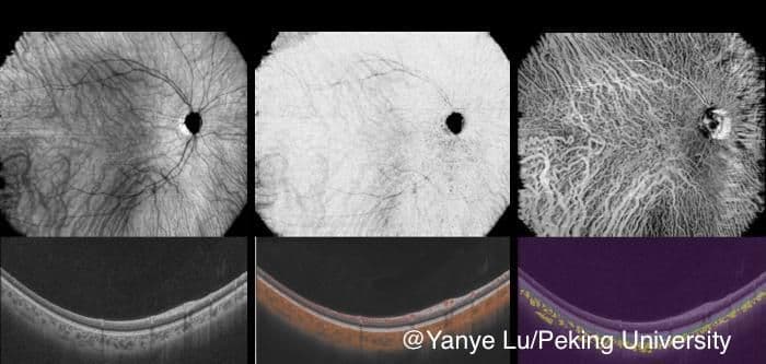 A team of researchers from Peking University have developed an innovative, noninvasive choroidal angiography technique that enables layer-wise visualization and assessment of choroidal vessels using deep learning. (Image credit: Yanye Lu, Peking University)