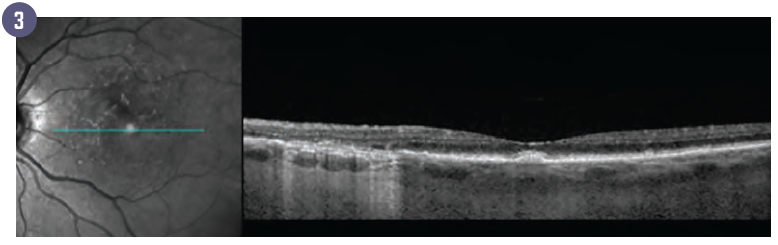 Figure 3: Early signs of GA are noted in the left side of the scan image, including hyperre ective foci, wedge defect, and outer retinal qtrophy (iRORA) Complete RPE and outer retinal atrophy (cRORA) is also present.