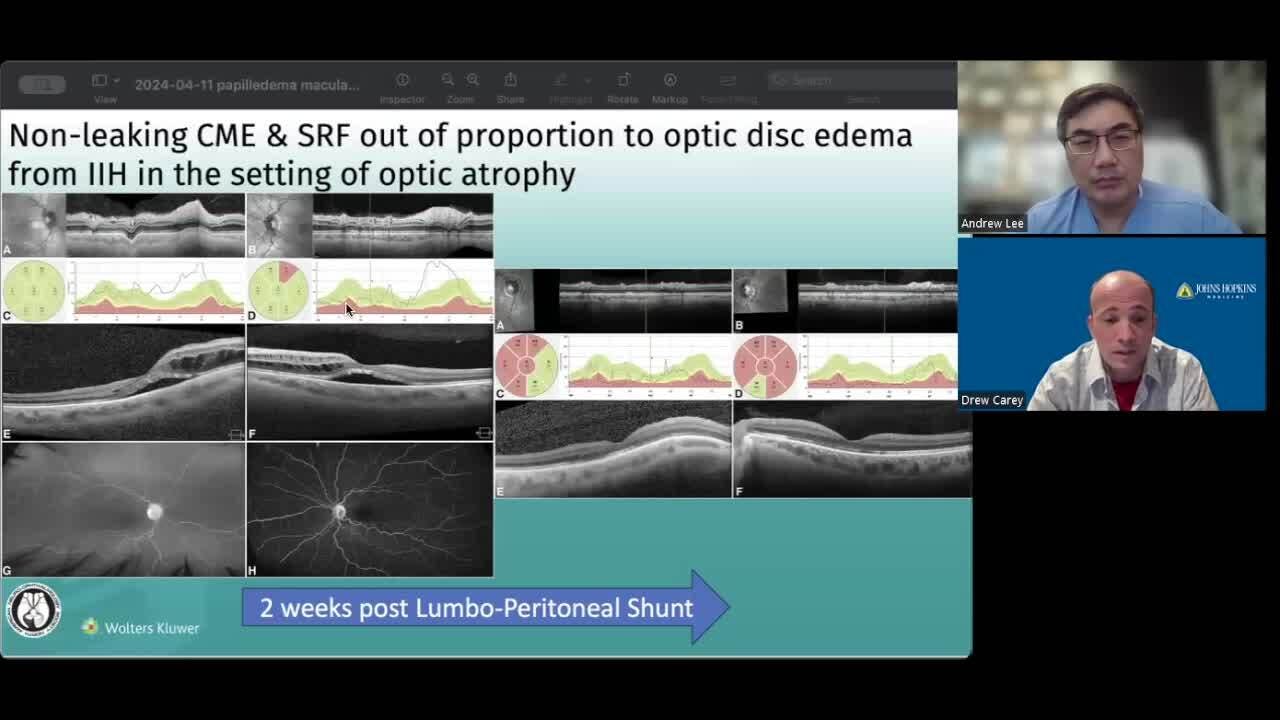 VLOG: NeuroOp Guru: Nonleaking CRF and SRF out of proportion to optic disc edema from IIH