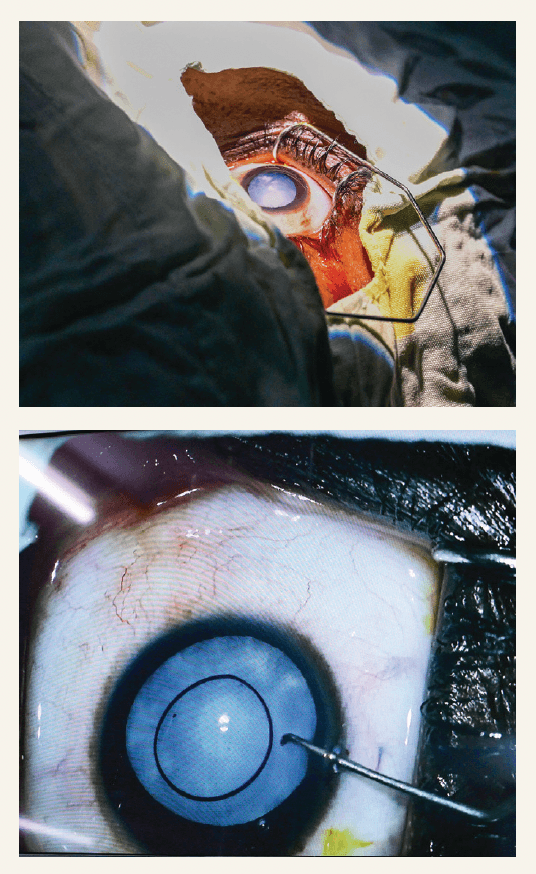 Eyes during bag-in-lens surgery. (Images courtesy of Nils-Erik Boonstra, MD)