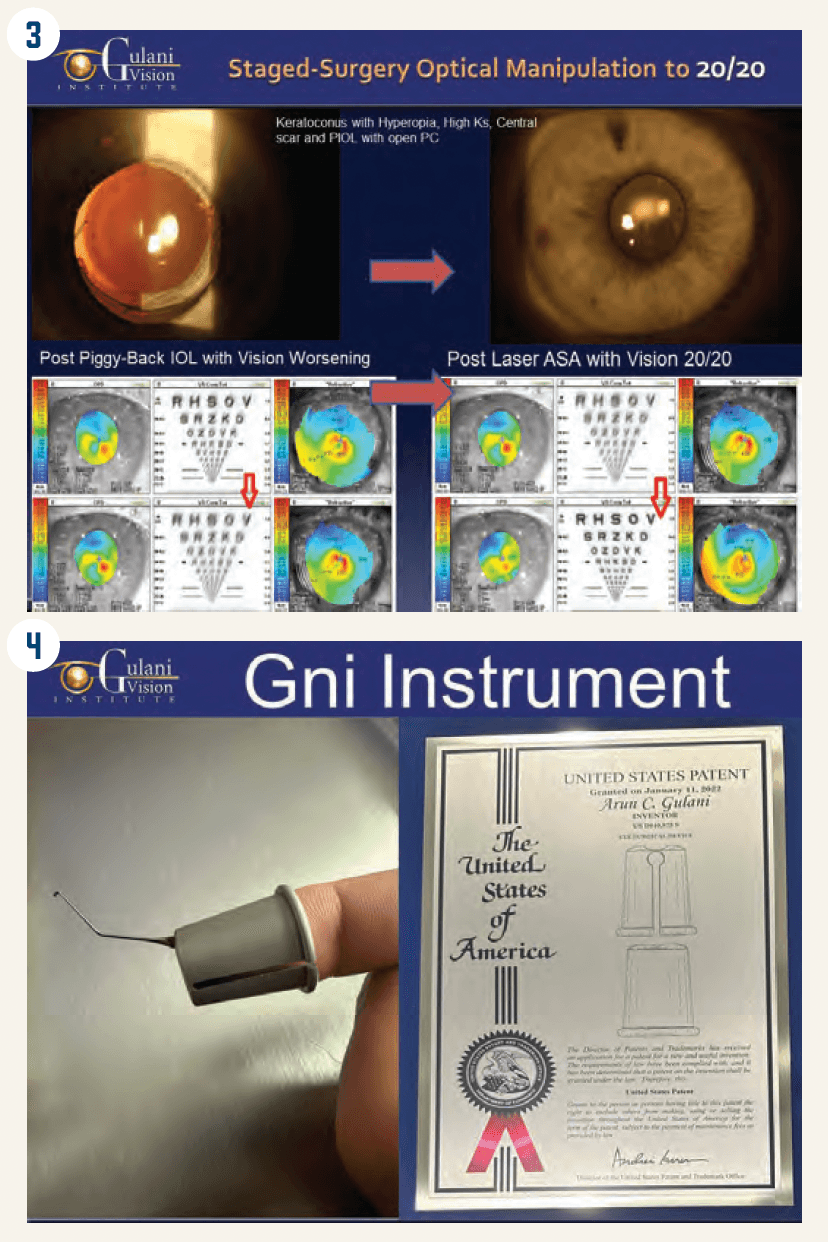 Figure 3. Fixing surgical complications with Intacs and

surgery. 

Figure 4. The Gni instrument. (Images courtesy of

Arun Gulani, MD)