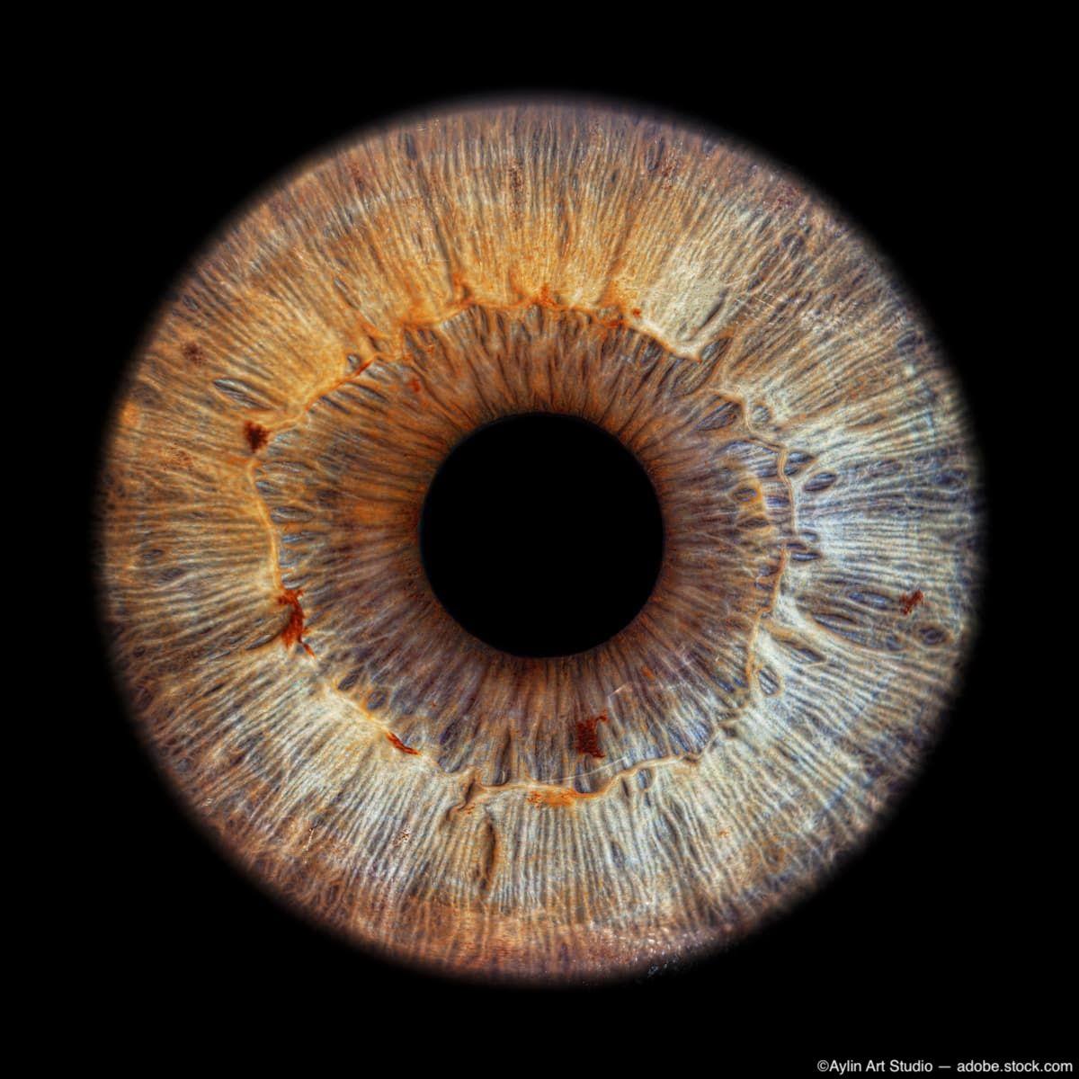 Iris freckles: Potential biomarker for AMD