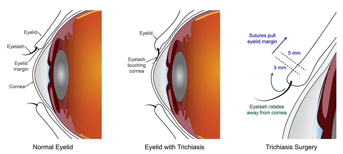 On a normal eyelid (left), eyelashes are turned outward away from the cornea. Eyelids affected by trichiasis (center) have eyelashes touching the eye. Surgery for eyelids affected by trichiasis (right), rotates the eyelash away from the cornea, returning them to their normal anatomic position. (Image credit: National Eye Institute)