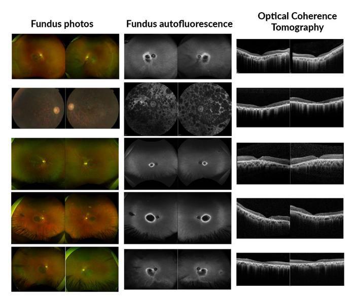 Ophthalmic images from 5 of the patients in the study demonstrate significant variability in the forms of retinal dystrophy. (Image credit: Bin Guan, PhD)