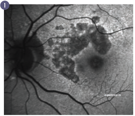 Figure 1: Hypoautofluorescence.