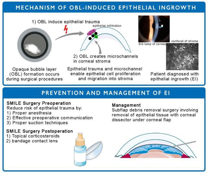 This study identifies mechanisms of epithelial growth post-SMILE surgery and suggests preventive and treatment measures, including subflap debris removal, to address corneal epithelial ingrowth. (Image credit: MedComm-Future Medicine)