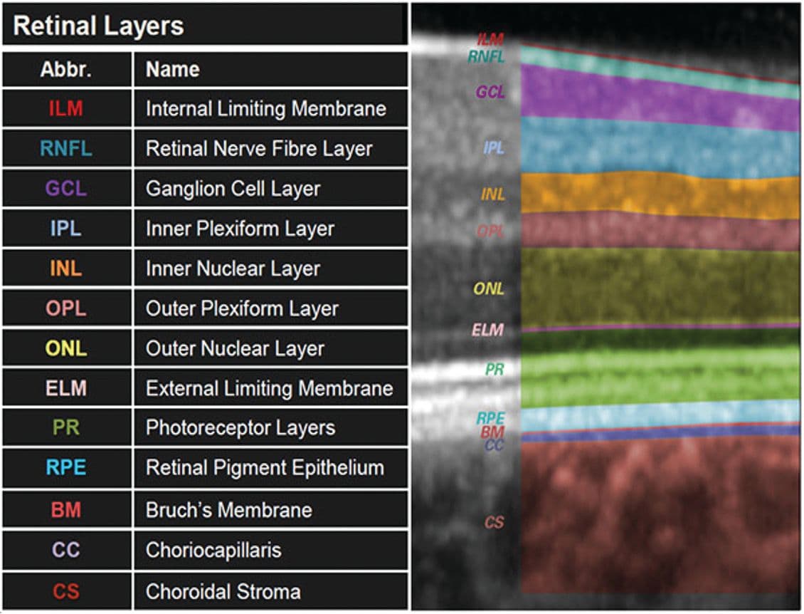 Retinal Layer Segmentation as Seen on an OCT Scan. (Image courtesy of Heidelberg Engineering)