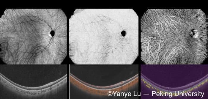 Noninvasive choroidal vessel analysis using deep learning: A novel approach to OCT angiography