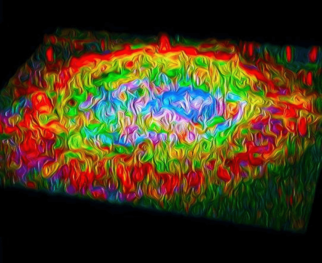 An artist’s rendition of a choroidal neovascular lesion in a choroidal flat mount demonstrating expression of the transcription factor, hypoxia-inducible factor (HIF)-1⍺ (red) in RPE cells (green) in mouse eyes treated with aflibercept. (Image credit: Isabella Sodhi, McDonogh School)