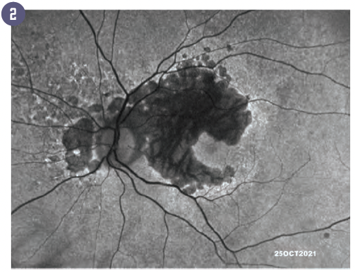 Figure 2: Hyperautofluorescent retinal pigment epithelium (RPE) cells along the border of the geographic atrophy (GA).