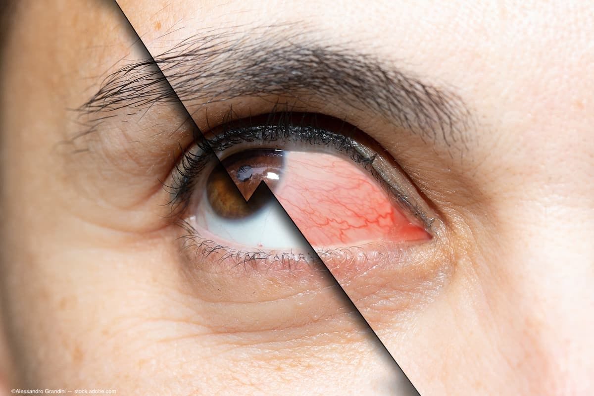 Challenging the conventional thinking in dry eye treatment