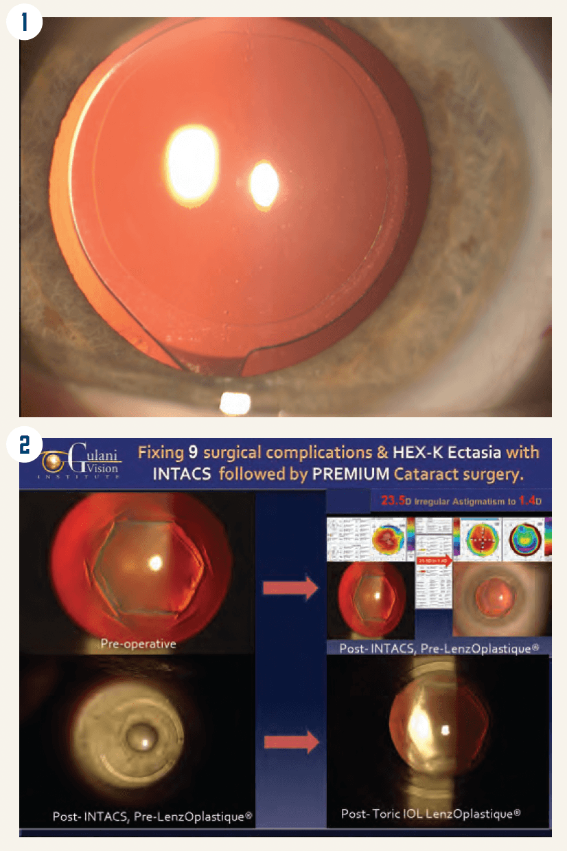 Figure 1. A view of the lens-based optics.

Figure 2. Staged-surgery optical manipulation.